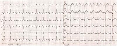 Targeted Temperature Management for In-hospital Cardiac Arrest Caused by Thyroid Storm: A Case Report